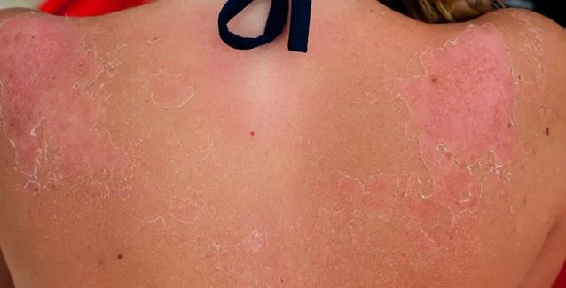 «Βούτυρο για το έγκαυμα» και άλλοι καλοκαιρινοί μύθοι για την υγεία της επιδερμίδας