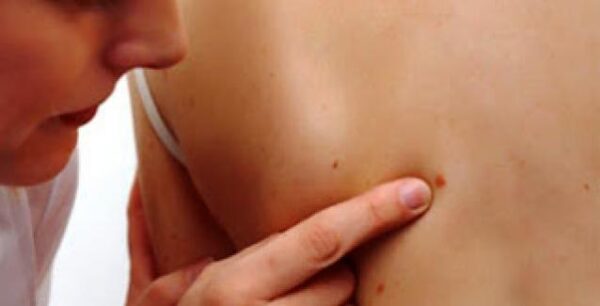 Μεγάλη προσοχή: Αν δείτε αυτό το κόκκινο σημάδι τρέξτε αμέσως στον γιατρό