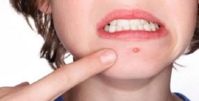 Σταφυλόκοκκος στα παιδιά: Όλα όσα οφείλουν να γνωρίζουν οι γονείς