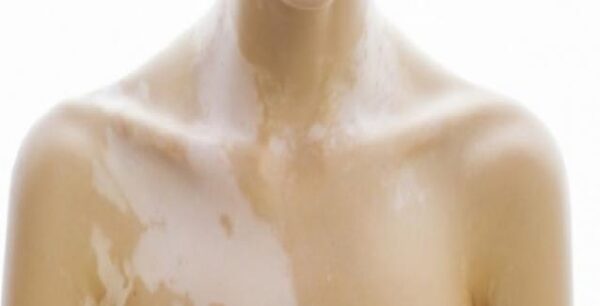 Λεύκη: Πώς να προστατευτείτε το καλοκαίρι