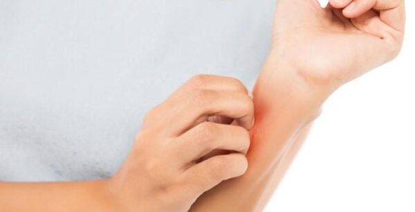 Ροδόχρους πιτυρίαση: Συμπτώματα και τρόποι αντιμετώπισης