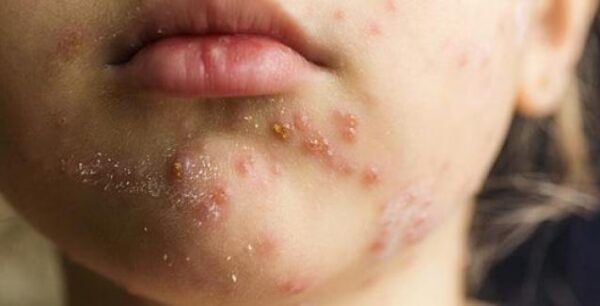 18 κρούσματα ιλαράς στην Κορινθία! (βίντεο)