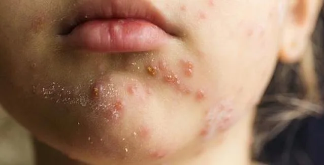 18 κρούσματα ιλαράς στην Κορινθία! (βίντεο)