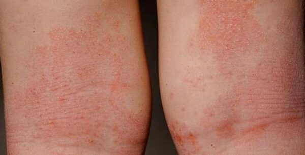 Δερματίτιδα: Αίτια και αντιμετώπιση των εξανθημάτων