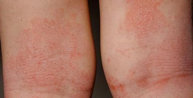 Δερματίτιδα: Αίτια και αντιμετώπιση των εξανθημάτων