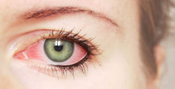 Τι να τρώτε για να μην πάθετε γλαύκωμα στα μάτια