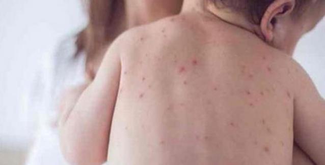 ΕΟΔΥ: Αναμένεται αύξηση στα κρούσματα ιλαράς  – Ανησυχία για αναζωπύρωση στην Ευρώπη