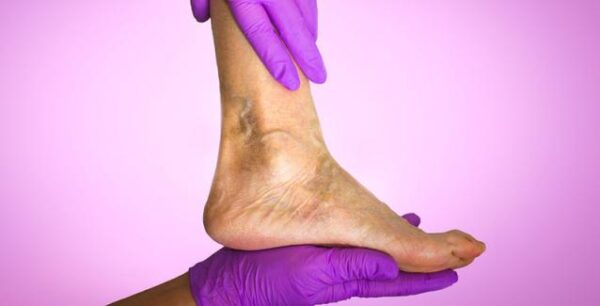 Οίδημα ποδιών και αστραγάλων: Με ποιες παθήσεις συνδέεται