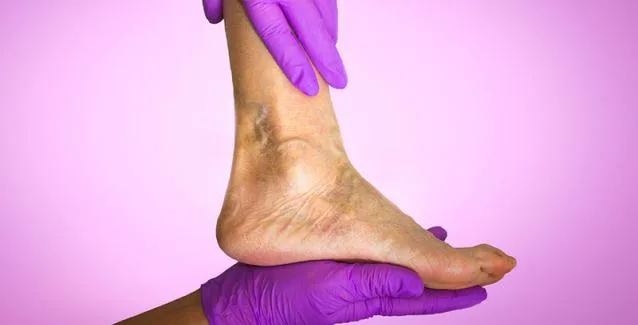 Οίδημα ποδιών και αστραγάλων: Με ποιες παθήσεις συνδέεται