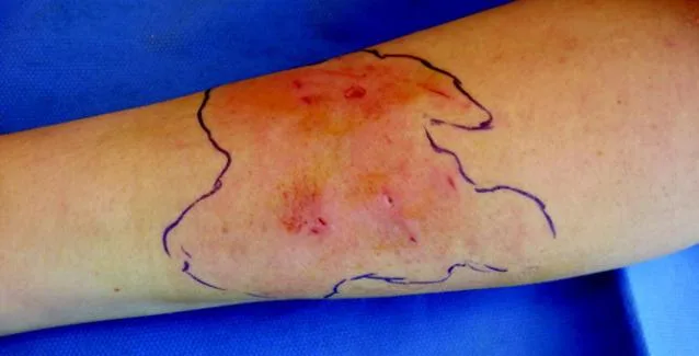 Σταφυλόκοκκος: ΟΛΑ τα συμπτώματα για να ξέρετε αν έχετε μολυνθεί