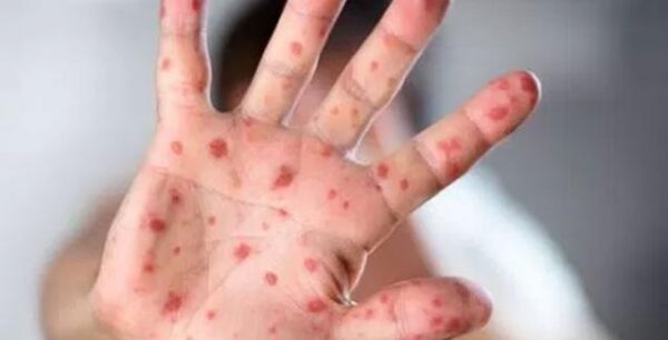 200 τα κρούσματα ιλαράς στην Ελλάδα