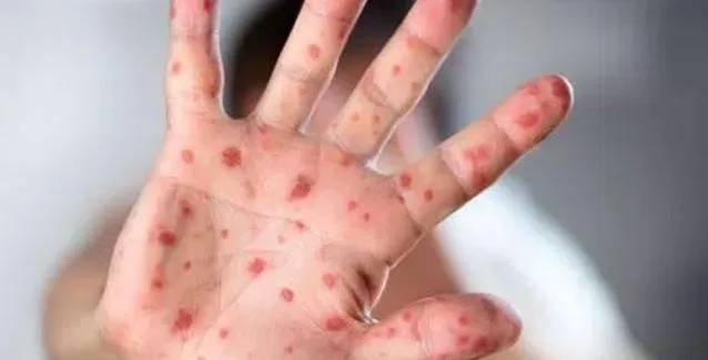 200 τα κρούσματα ιλαράς στην Ελλάδα