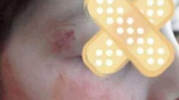 Πάτρα: Μητέρα πήρε χτυπημένο το παιδί της από το σχολείο -Χρειάστηκε και ράμματα