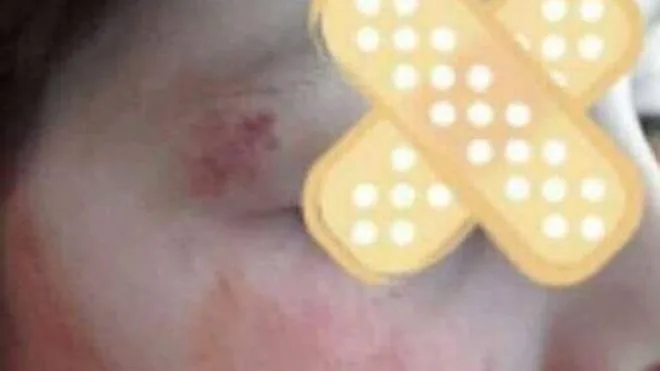 Πάτρα: Μητέρα πήρε χτυπημένο το παιδί της από το σχολείο -Χρειάστηκε και ράμματα