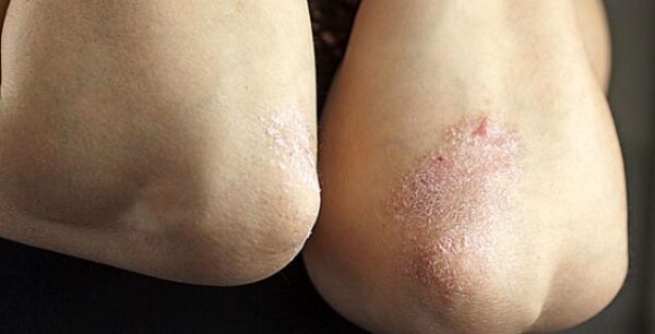 Στο 10% μειώθηκε η συμμετοχή των ασθενών με ψωρίαση σε ορισμένες θεραπείες