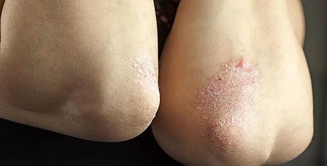 Στο 10% μειώθηκε η συμμετοχή των ασθενών με ψωρίαση σε ορισμένες θεραπείες