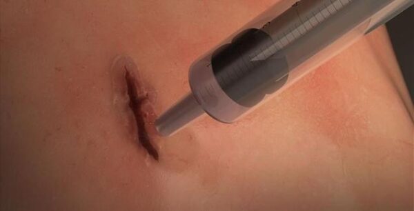 Επαναστατική χειρουργική κόλλα κλείνει τραύματα μέσα σε ένα λεπτό