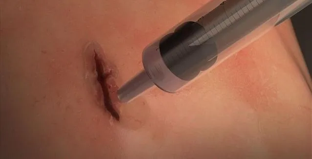 Επαναστατική χειρουργική κόλλα κλείνει τραύματα μέσα σε ένα λεπτό
