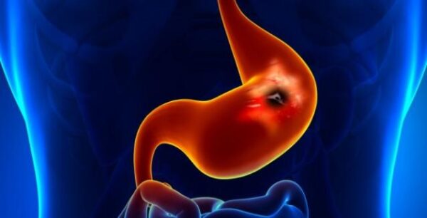 Έλκος στο στομάχι: Ποια είναι τα συμπτώματα;
