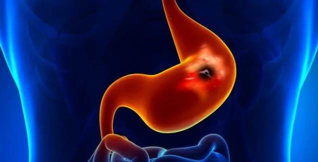 Έλκος στο στομάχι: Ποια είναι τα συμπτώματα;