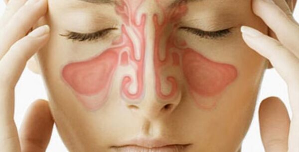 Ιγμορίτιδα: Πόσο διαρκεί – Τι να κάνετε για πονοκέφαλο και μπούκωμα