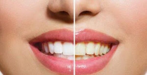 Τρεις τροφές που κιτρινίζουν τα δόντια