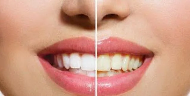 Τρεις τροφές που κιτρινίζουν τα δόντια
