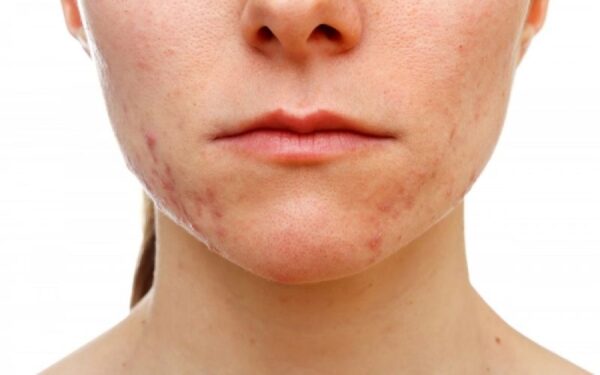 Έρευνα: Με τι συνδέεται η  εμφάνιση ακμής