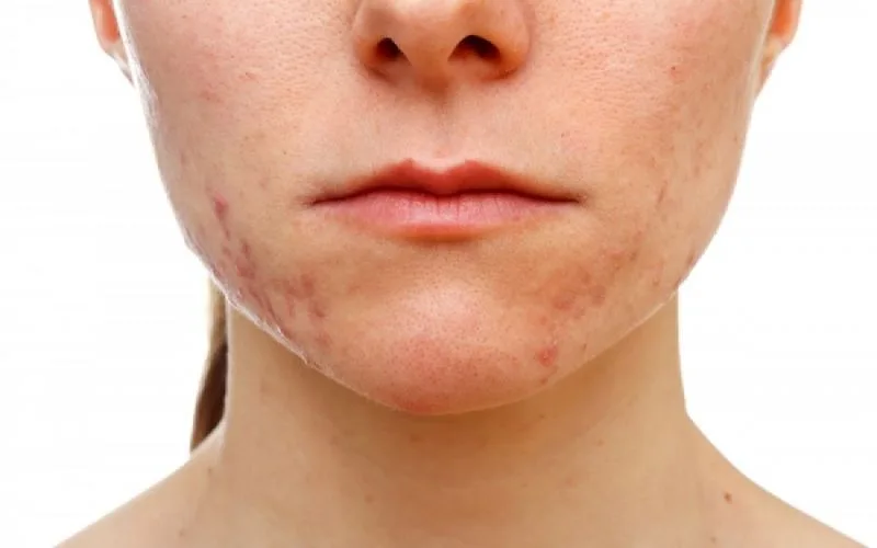 Έρευνα: Με τι συνδέεται η  εμφάνιση ακμής