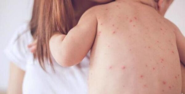 «Καλπάζει» η ιλαρά: Άλλα 100 κρούσματα την τελευταία εβδομάδα