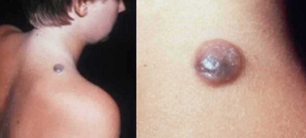 Αυξάνεται η θνησιμότητα του μελανώματος στους άνδρες διεθνώς