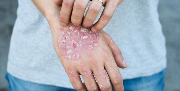 Ψωρίαση: 6 διατροφικές αλλαγές για τη βελτίωση των συμπτωμάτων