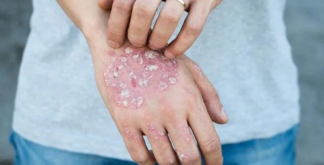 Ψωρίαση: 6 διατροφικές αλλαγές για τη βελτίωση των συμπτωμάτων