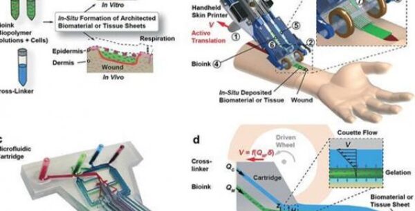 Βιοεκτυπωτής τοποθετεί ιστούς δέρματος σε βαθιά τραύματα μέσα σε δύο λεπτά