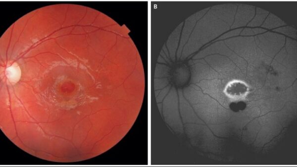 Εννιάχρονο αγόρι έχασε το 80% της όρασής του παίζοντας με δείκτη λέιζερ