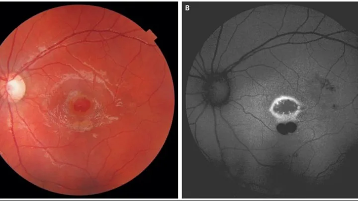Εννιάχρονο αγόρι έχασε το 80% της όρασής του παίζοντας με δείκτη λέιζερ
