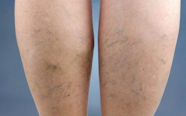 Οι ψηλοί άνθρωποι κινδυνεύουν περισσότερο να εμφανίσουν κιρσούς