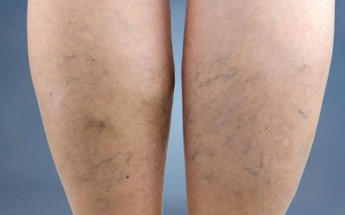 Οι ψηλοί άνθρωποι κινδυνεύουν περισσότερο να εμφανίσουν κιρσούς