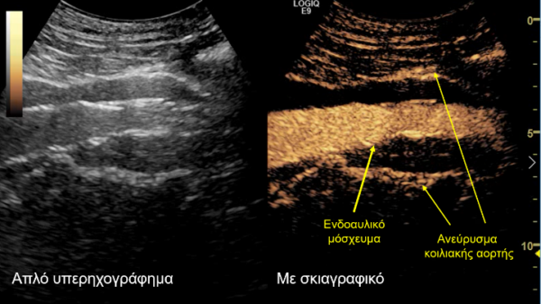 Νέα, πρωτοποριακή τεχνική για τη θεραπεία υπερνεφρικού ανευρύσματος της αορτής