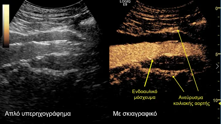 Νέα, πρωτοποριακή τεχνική για τη θεραπεία υπερνεφρικού ανευρύσματος της αορτής