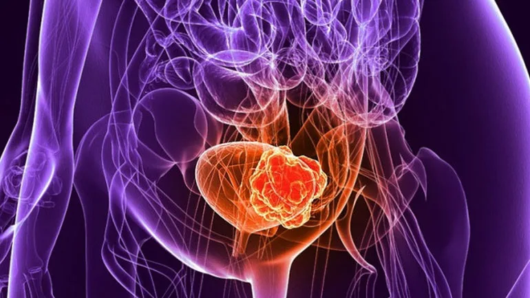 Αυξημένος ο κίνδυνος καρκίνου της ουροδόχου κύστης για τις γυναίκες με πρόωρη εμμηνόπαυση