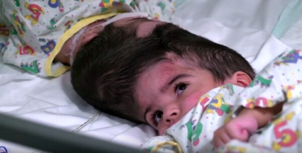 Επιτυχής διαχωρισμός σιαμαίων με ενωμένα κεφάλια μετά από 50 ώρες χειρουργείο