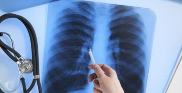 Καρκίνος του πνεύμονα: 7.000 νέες περιπτώσεις τον χρόνο στην Ελλάδα