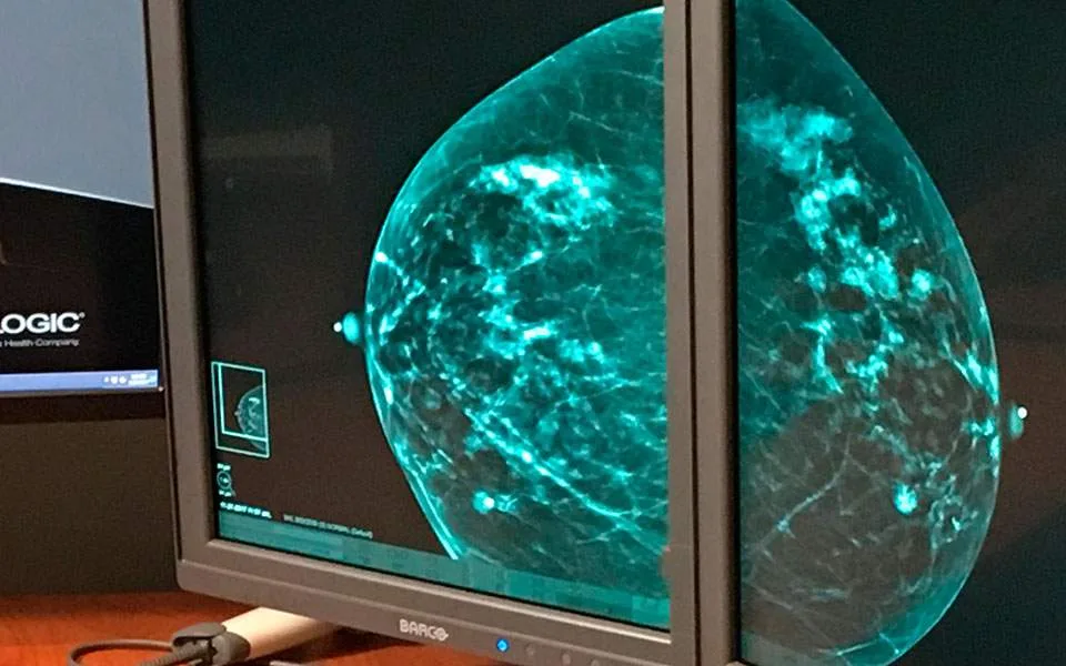 Νέα ανοσοθεραπεία μειώνει τον κίνδυνο υποτροπής του επιθετικού καρκίνου του μαστού