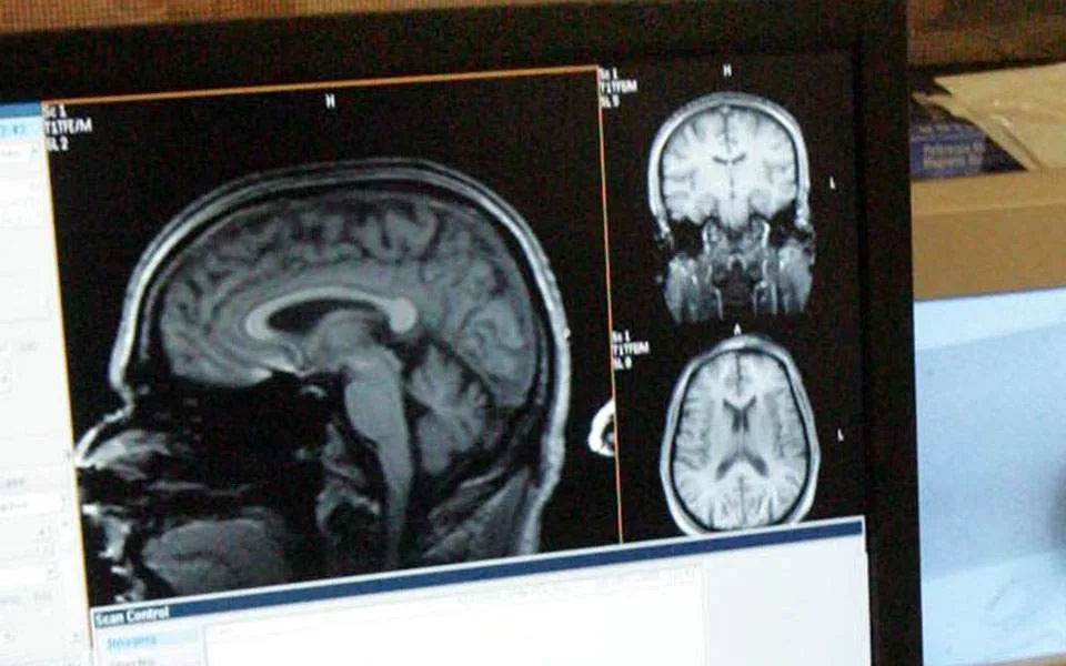 Νέα βήματα από Ελληνες επιστήμονες για πιο εξατομικευμένες θεραπείες στη σχιζοφρένεια